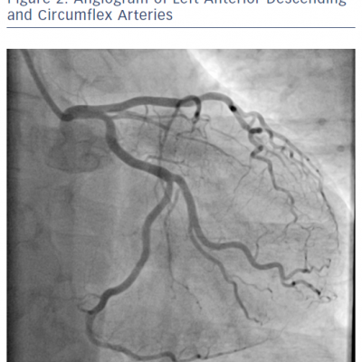 Angiogram of Left Anterior Descending and Circumflex Arteries