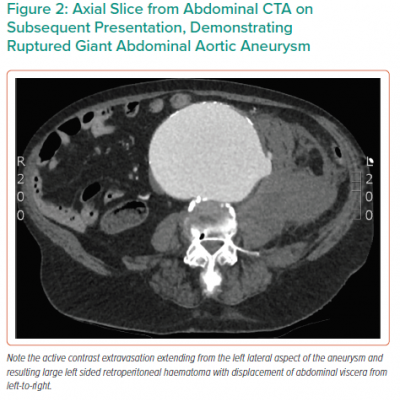 Axial Slice from Abdominal CTA on Subsequent Presentation Demonstrating Ruptured Giant Abdominal Aortic Aneurysm