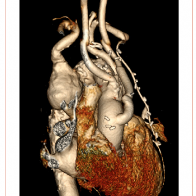 CT Reconstruction Illustrating a Debranched Left Common Carotid Artery and Subclavian Artery