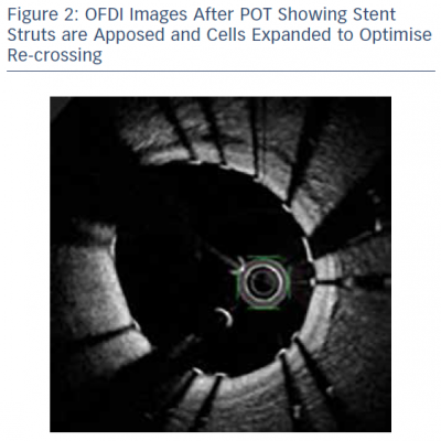 OFDI Images After POT Showing Stent Struts are Apposed and Cells Expanded to Optimise Re-crossing