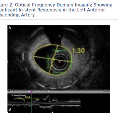 Optical Frequency Domain Imaging Showing Significant In-stent Restenosis in the Left Anterior Descending Artery