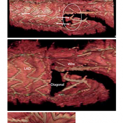 3D OFDI Images Confirm Re-crossing of the Wire at the Distal Cell Strut Adjacent to the Carina