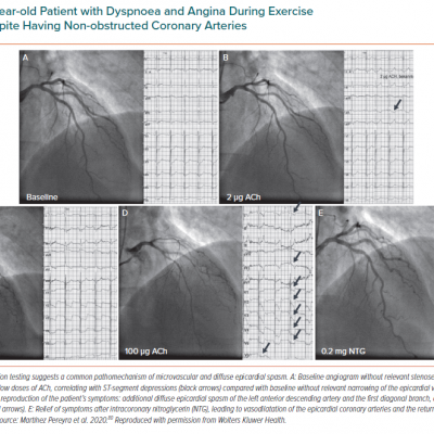 A 53-year-old Patient with Dyspnoea and Angina During Exercise and At Rest Despite Having Non-obstructed Coronary Arteries