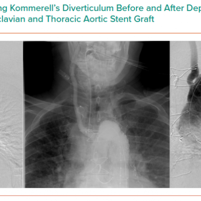 Angiography Illustrating Kommerell’s Diverticulum Before and After Deployment of Amplatzer Plug to Right Subclavian and Thoracic Aortic Stent Graft