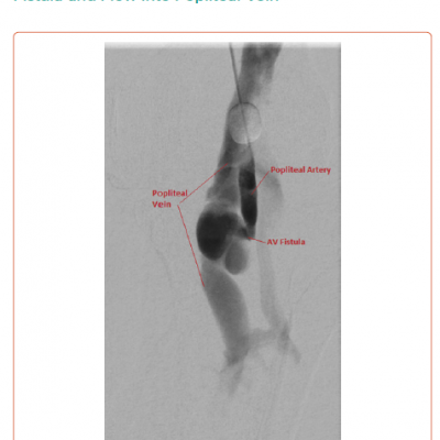 Digital Subtraction Angiography of Popliteal Artery Showing Large Arteriovenous Fistula and Flow Into Popliteal Vein