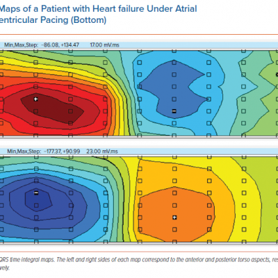 QRS Integral Maps of a Patient with Heart failure Under Atrial Pacing Top and Left Ventricular Pacing Bottom