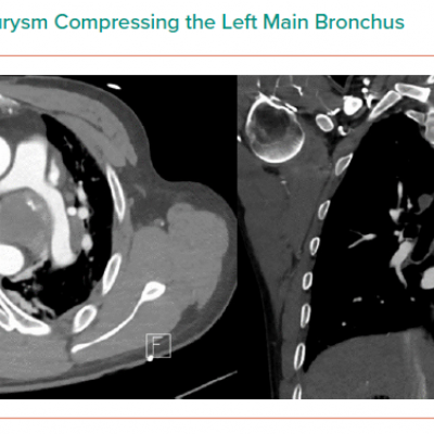 Ruptured Thoracic Aneurysm Compressing the Left Main Bronchus