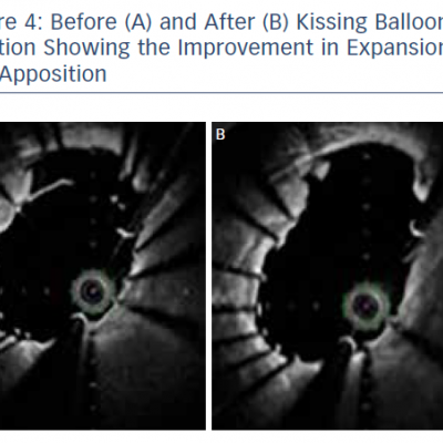 Before A and After B Kissing Balloon Inflation Showing the Improvement in Expansion and Apposition 