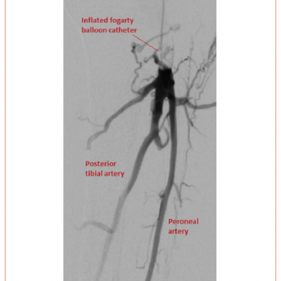 Digital Subtraction Angiography of the Below-knee Runoff Vessels with Temporary Occlusion of Flow Through the Arteriovenous Fistula Using a Fogarty Balloon