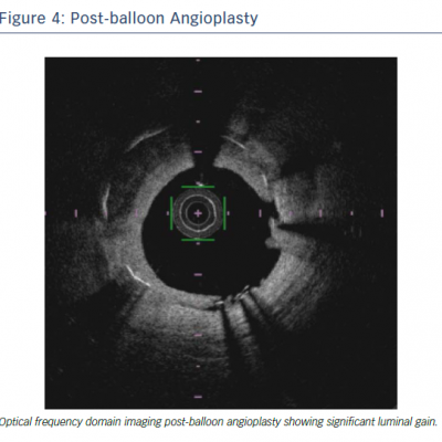 Post-balloon Angioplasty