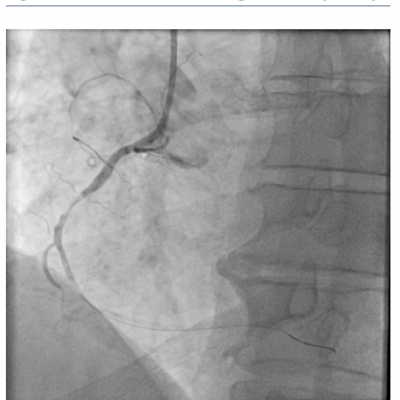 0.014” Wire in Distal Right Coronary Artery