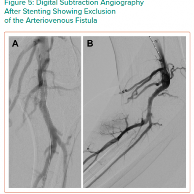 Digital Subtraction Angiography After Stenting Showing Exclusion of the Arteriovenous Fistula