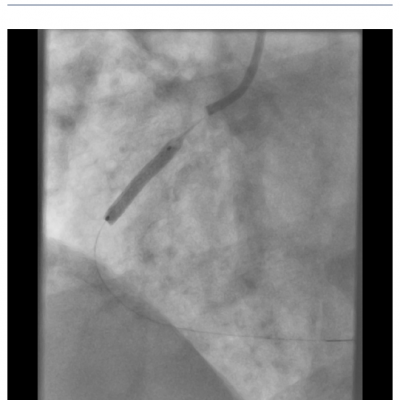 Drug-eluting Stent Deployment