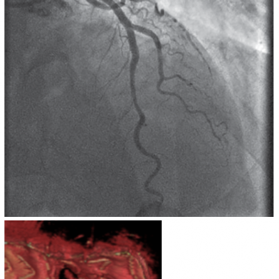 Final Angiographic and 3D OFDI Images Confirming a Good Result