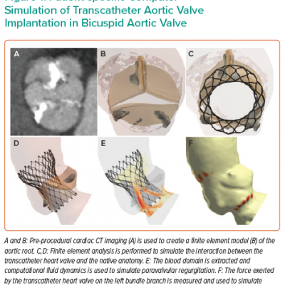 Patient-specific Computer Simulation of Transcatheter Aortic Valve Implantation in Bicuspid Aortic Valve