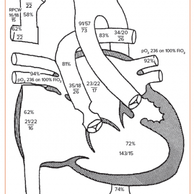 Schematic Diagram of the Palliated Heart