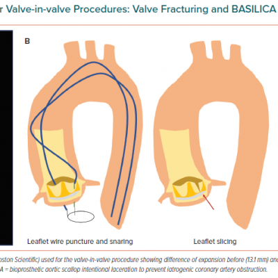 Tips and Tricks for Valve-in-valve Procedures Valve Fracturing and BASILICA