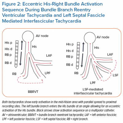 Eccentric His-Right Bundle Activation Sequence During Bundle Branch Reentry Ventricular Tachycardia and Left Septal Fascicle Mediated Interfascicular Tachycardia