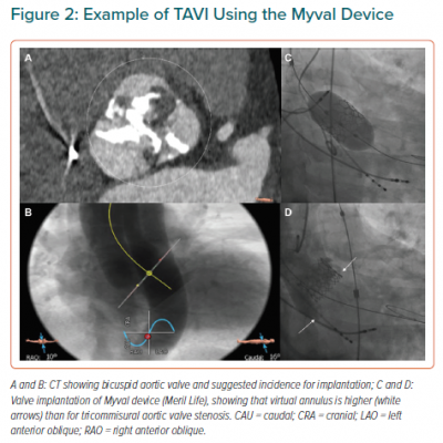 Example of TAVI Using the Myval Device