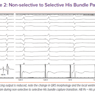 Non-selective to Selective His Bundle Pacing