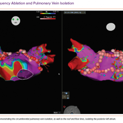 Radiofrequency Ablation and Pulmonary Vein Isolation