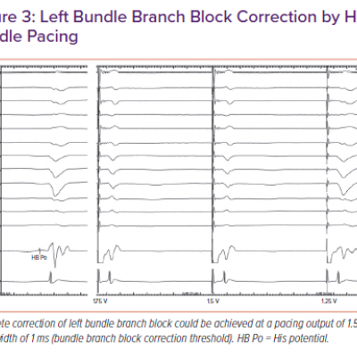 Left Bundle Branch Block Correction by His Bundle Pacing