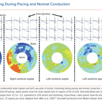 Systolic Shortening During Pacing and Normal Conduction