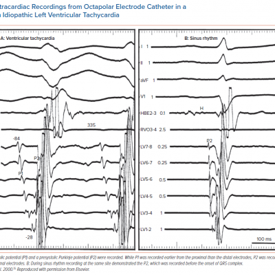 Intracardiac Recordings from Octapolar Electrode Catheter in a Patient with Idiopathic Left Ventricular Tachycardia