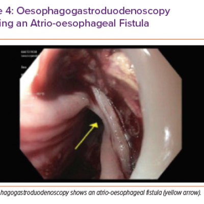 Oesophagogastroduodenoscopy Showing an Atrio-oesophageal Fistula