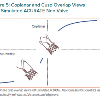 Coplanar and Cusp Overlap Views with Simulated ACURATE Neo Valve