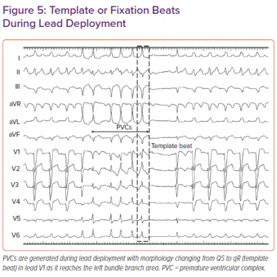 Template or Fixation Beats During Lead Deployment