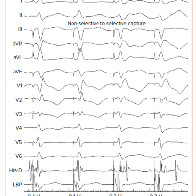 Non-selective to Selective Left Bundle Branch Capture