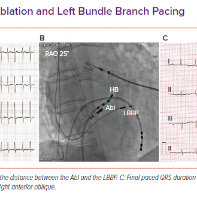 Atrioventricular Junction Ablation and Left Bundle Branch Pacing