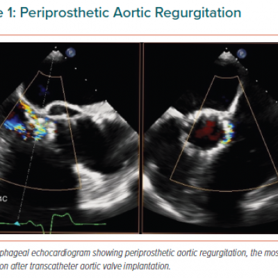 Periprosthetic Aortic Regurgitation