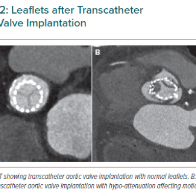 Leaflets after Transcatheter Aortic Valve Implantation