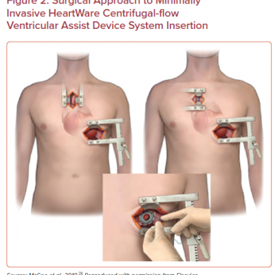 Surgical Approach to Minimally Invasive HeartWare Centrifugal-flow Ventricular Assist Device System Insertion