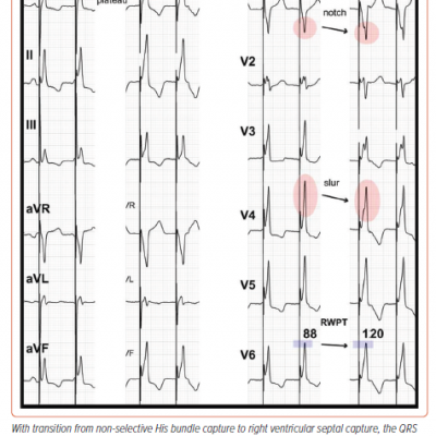 QRS Morphology Changes from Non-selective His Bundle to Right Ventricular Septal Capture