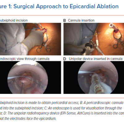 Surgical Approach to Epicardial Ablation