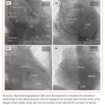 Angiographic Anatomy for Left Bundle Branch Pacing