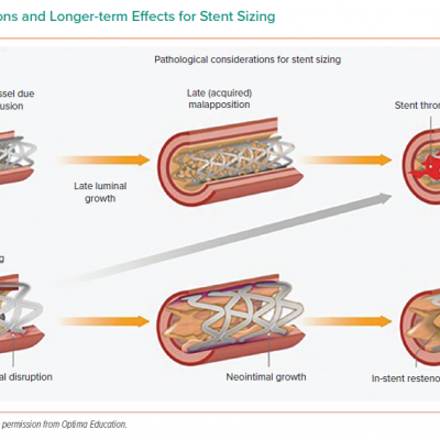 Considerations and Longer-term Effects for Stent Sizing