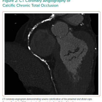 CT Coronary Angiography of Calcific Chronic Total Occlusion