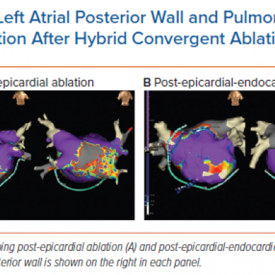 Left Atrial Posterior Wall and Pulmonary Vein Isolation After Hybrid Convergent Ablation