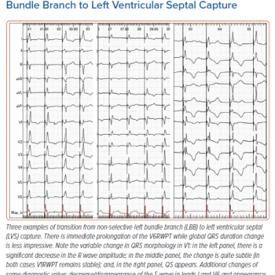 QRS Transition from Non-selective Left Bundle Branch to Left Ventricular Septal Capture