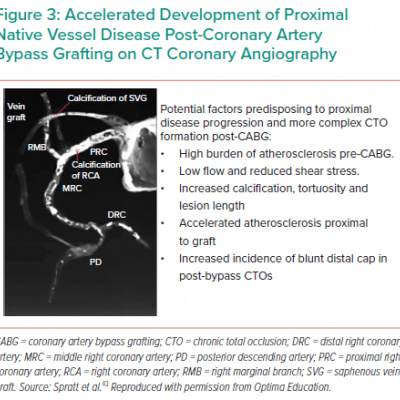 Accelerated Development of Proximal Native Vessel Disease Post-Coronary Artery Bypass Grafting on CT Coronary Angiography