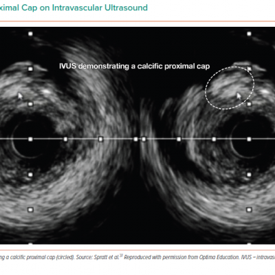 Calcific Proximal Cap on Intravascular Ultrasound