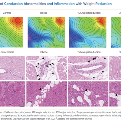 Reversal of Conduction Abnormalities and Inflammation with Weight Reduction