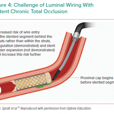 Challenge of Luminal Wiring With In-stent Chronic Total Occlusion