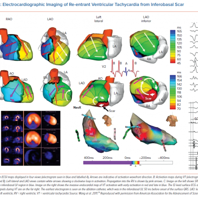 Electrocardiographic Imaging of Re-entrant Ventricular Tachycardia from Inferobasal Scar
