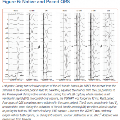 Native and Paced QRS