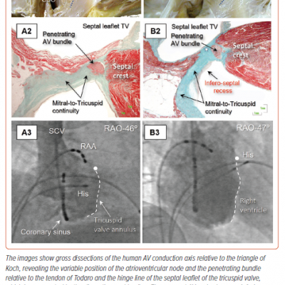 Variable Location of the Atrioventricular Node and the Penetrating Bundle